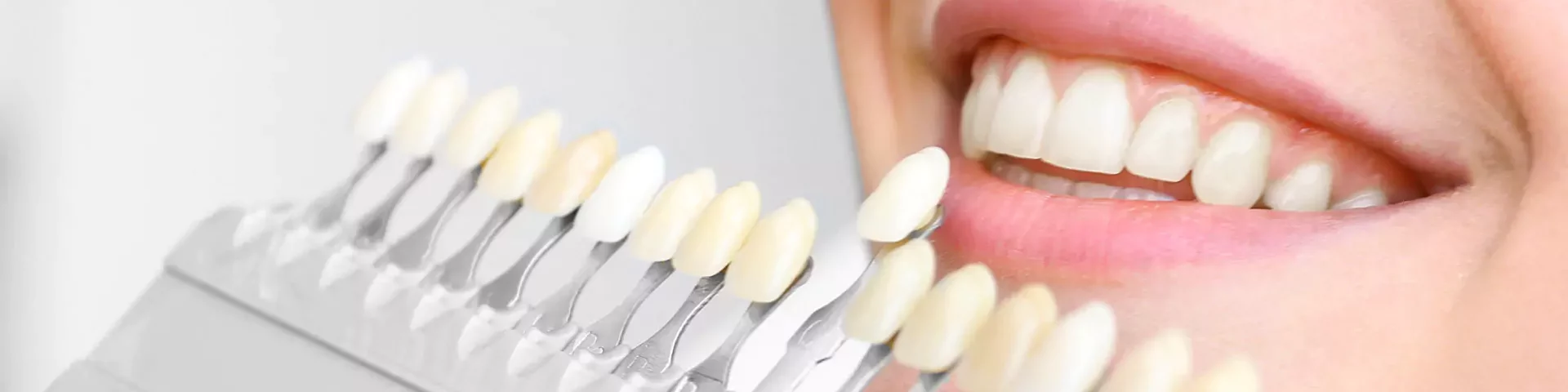 Abgleich Zahnfarbe mit Veneermodell Abgleich der Zahnfarbe mit dem Veneer bei der Ästhetische Zahnheilkunde