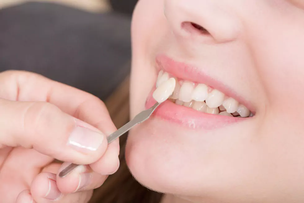 Abgleich Zahnfarbe mit Veneer Abgleich der Zahnfarbe mit dem Veneer bei der Zahnästhetischen Behandlung