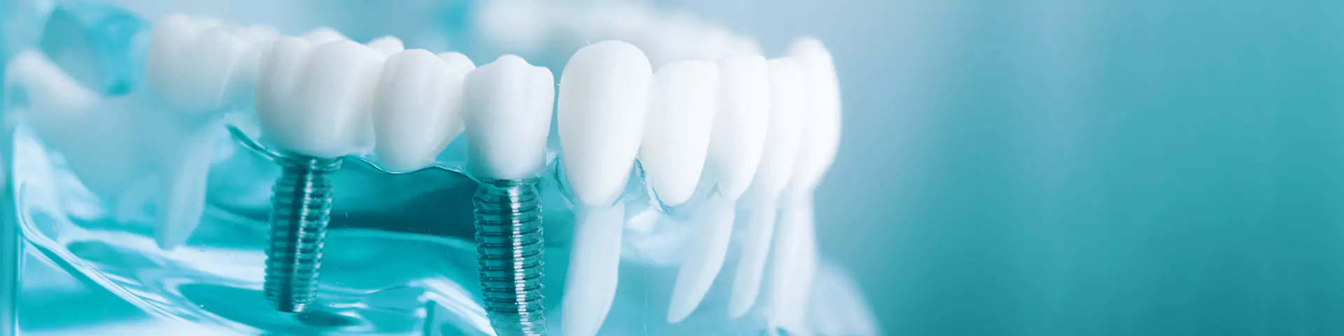 Unterkiefermodell mit Implantaten Implantologie & Oralchirurgie: Model eines Unterkiefers mit Zähnen und Implantaten